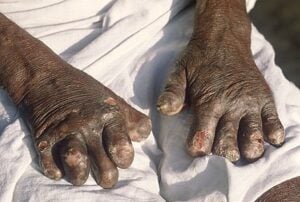 446px-Leprosy_deformities_hands